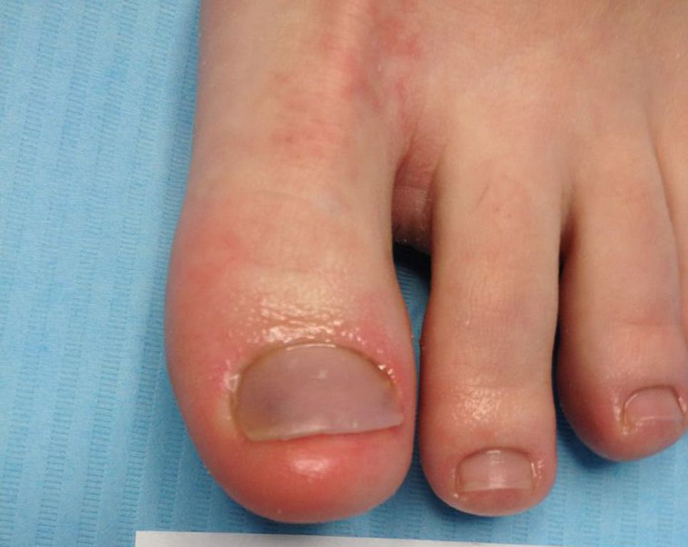 Efekty leczenia paznokci metodą Kostka Arkady