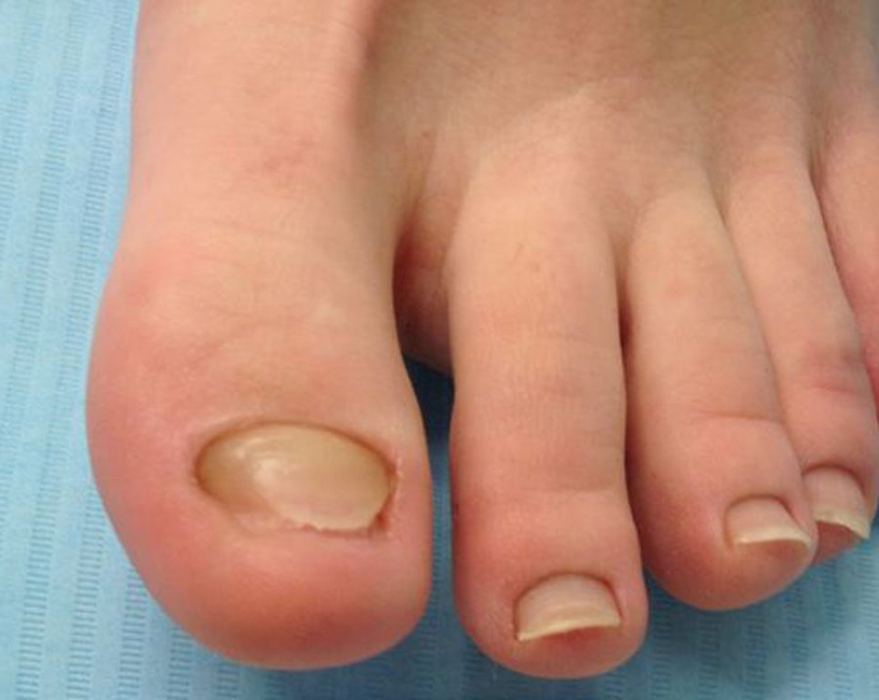 Efekt leczenia paznokci metodą Kostka Arkady